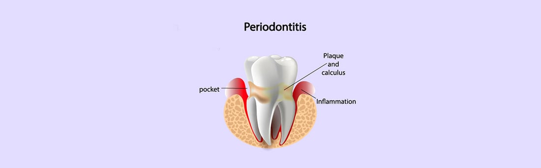 Periodontics in Welland, ON | Welland Dental Centre Medical illustration of periodontitis showing gum pockets, plaque, calculus and inflammation around a tooth