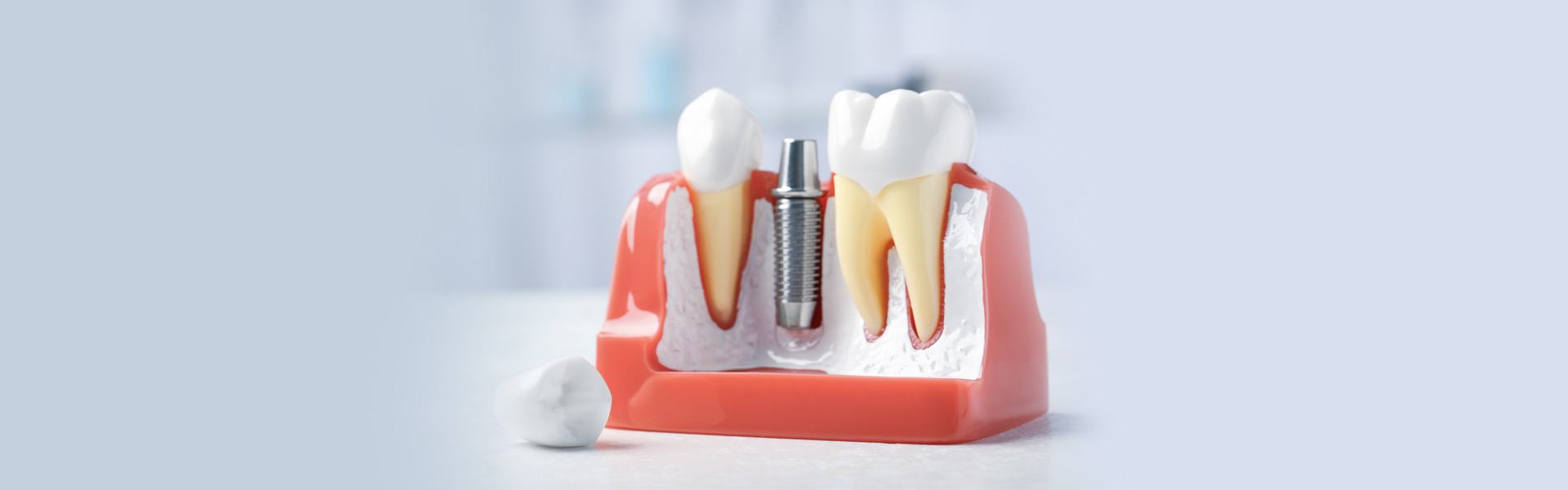 Why Dental Implants are the Best Option for Replacing Missing Teeth?