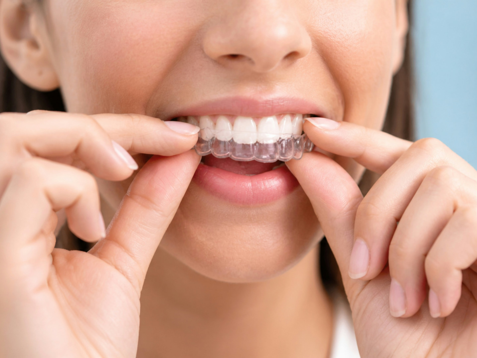 Patient placing a clear orthodontic aligner over her teeth