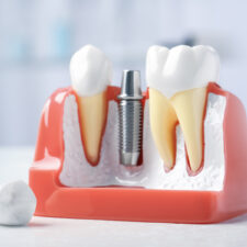 Dental implant model at Welland dental clinic.